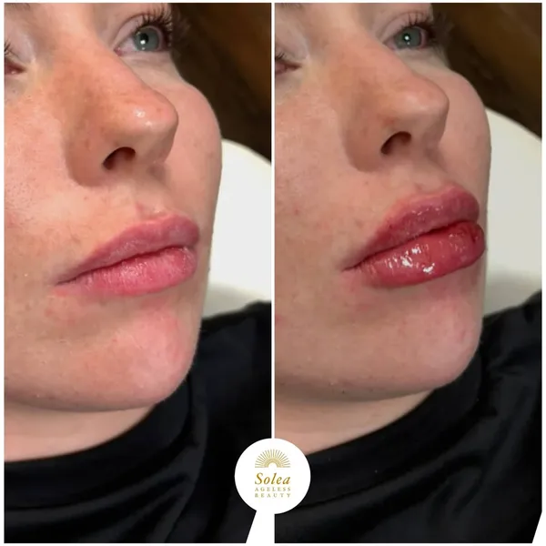 Before and after lip filler result