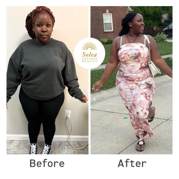 Before and after semaglutide weight loss result