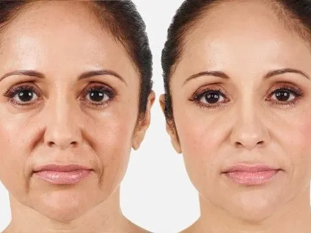 Before and after dermal filler